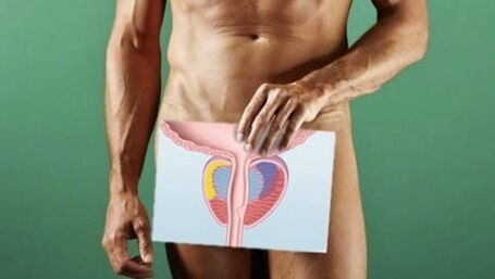 Prostatitis kongestiboaren profilaxiaren beharra duen gizona