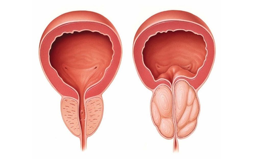 prostata normala eta hanturatua