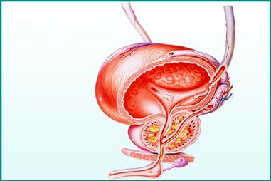 Prostatako hantura prostatitis akutuan sexu-muga bat da