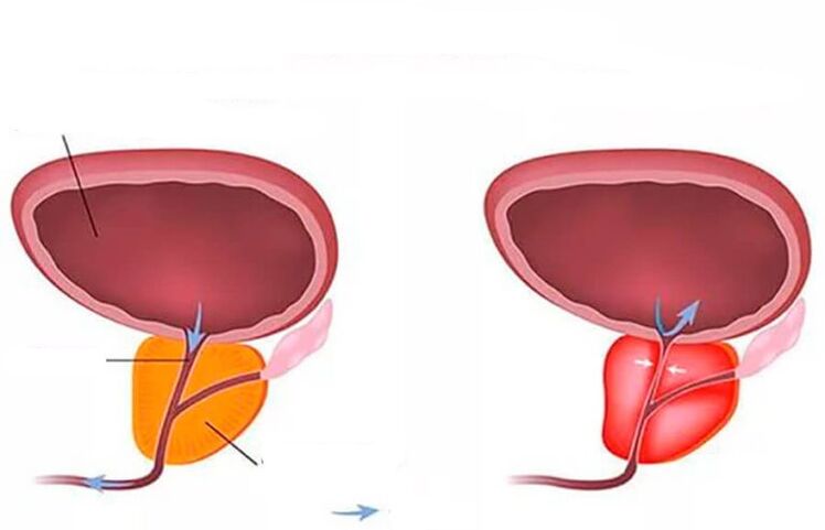 prostata normala eta hanturatua