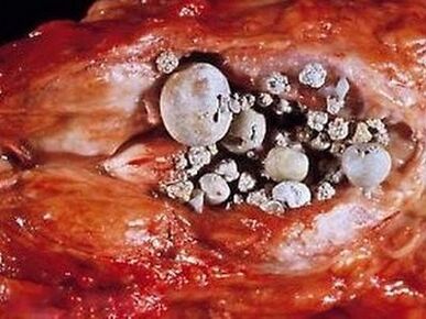 Harriak prostatako guruinean prostatitis kalkuluarekin