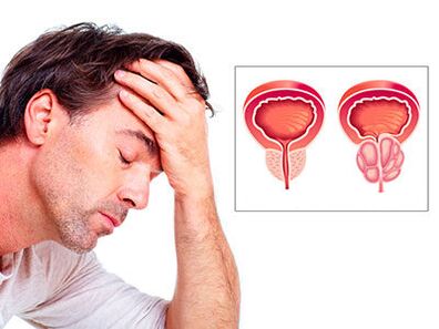 Prostatitisaren sintomek kezkatzen dute gizona